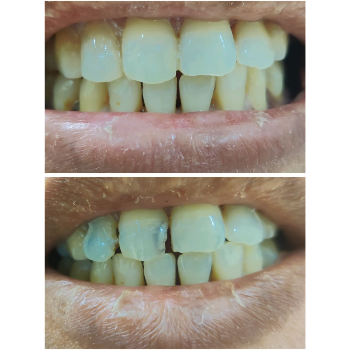 Clear Aligners Result