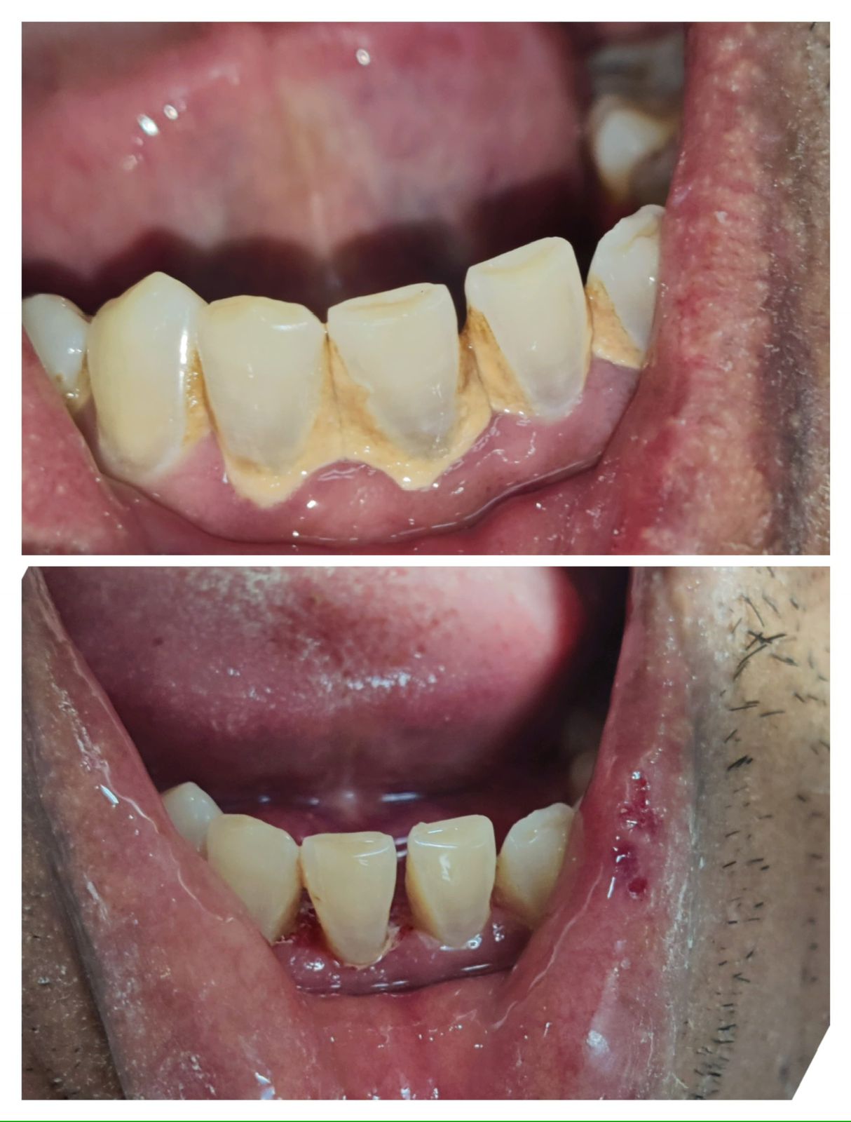 Denture Transformation Before After