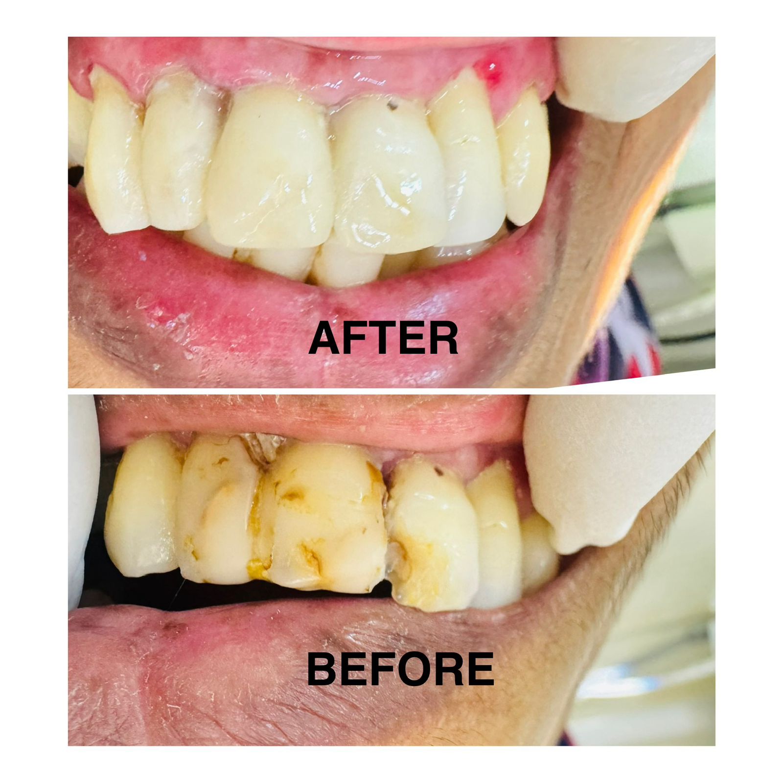 Orthodontic Treatment Before After