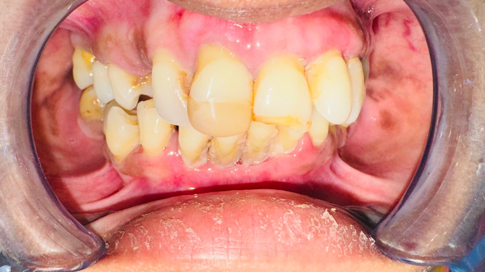 Root Canal Crown Before After